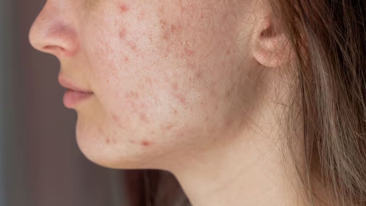 difference-between-melasma-and-hypermentation-in