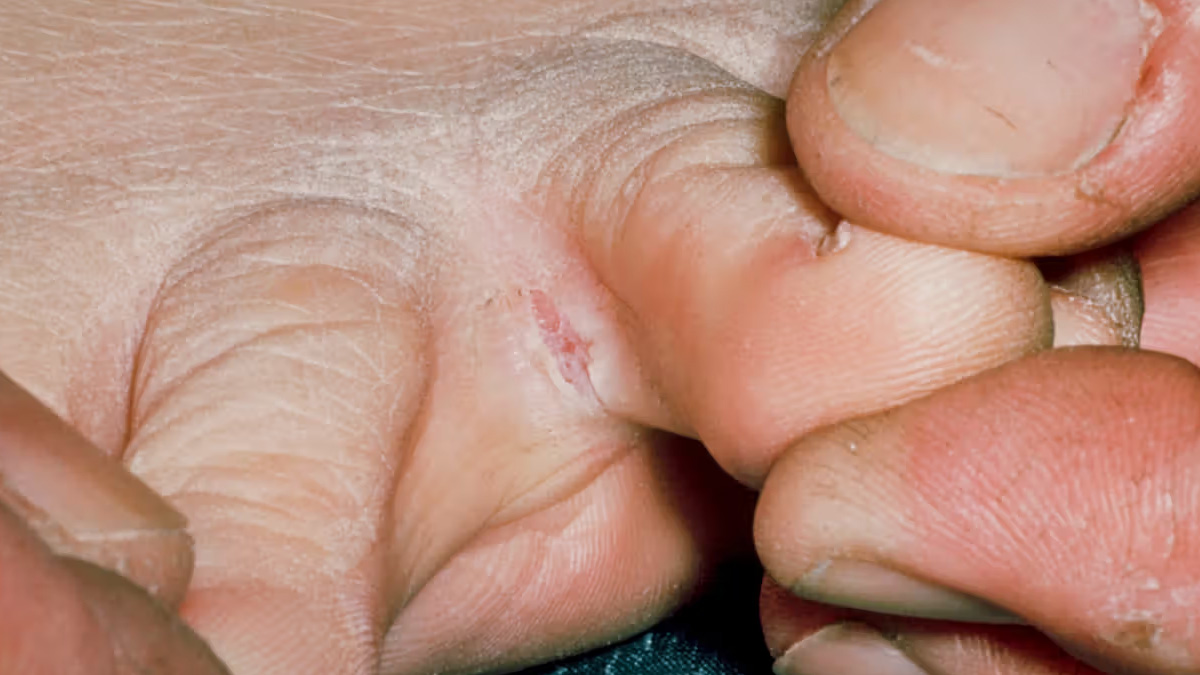 fungal-infection-between-fingers