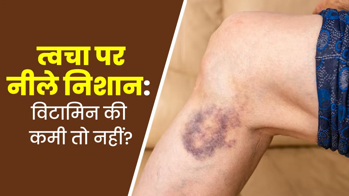 त्वचा पर अचानक उभर रहे हैं नीले धब्बे? इस विटामिन की कमी को न करें नजरअंदाज