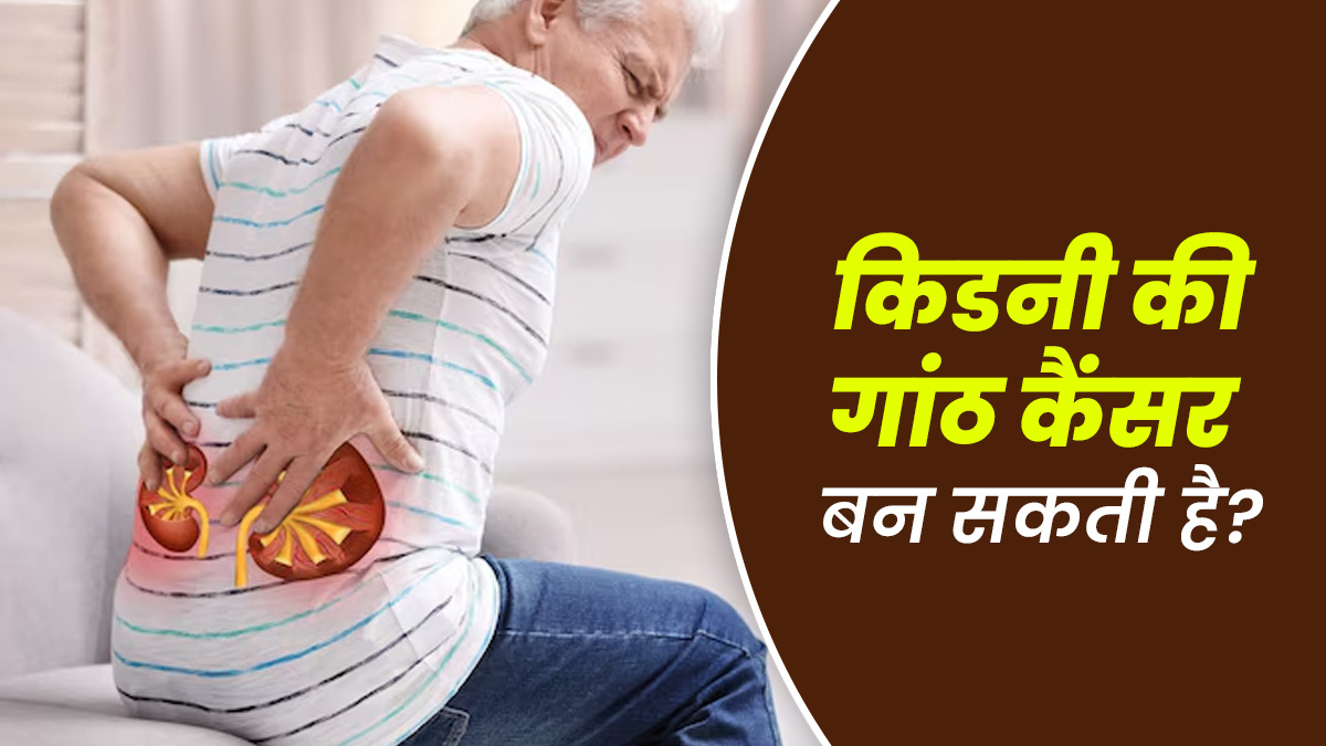 क्‍या सच में किडनी की गांठ धीरे-धीरे कैंसर बन जाती है? डॉक्‍टर से जानें
