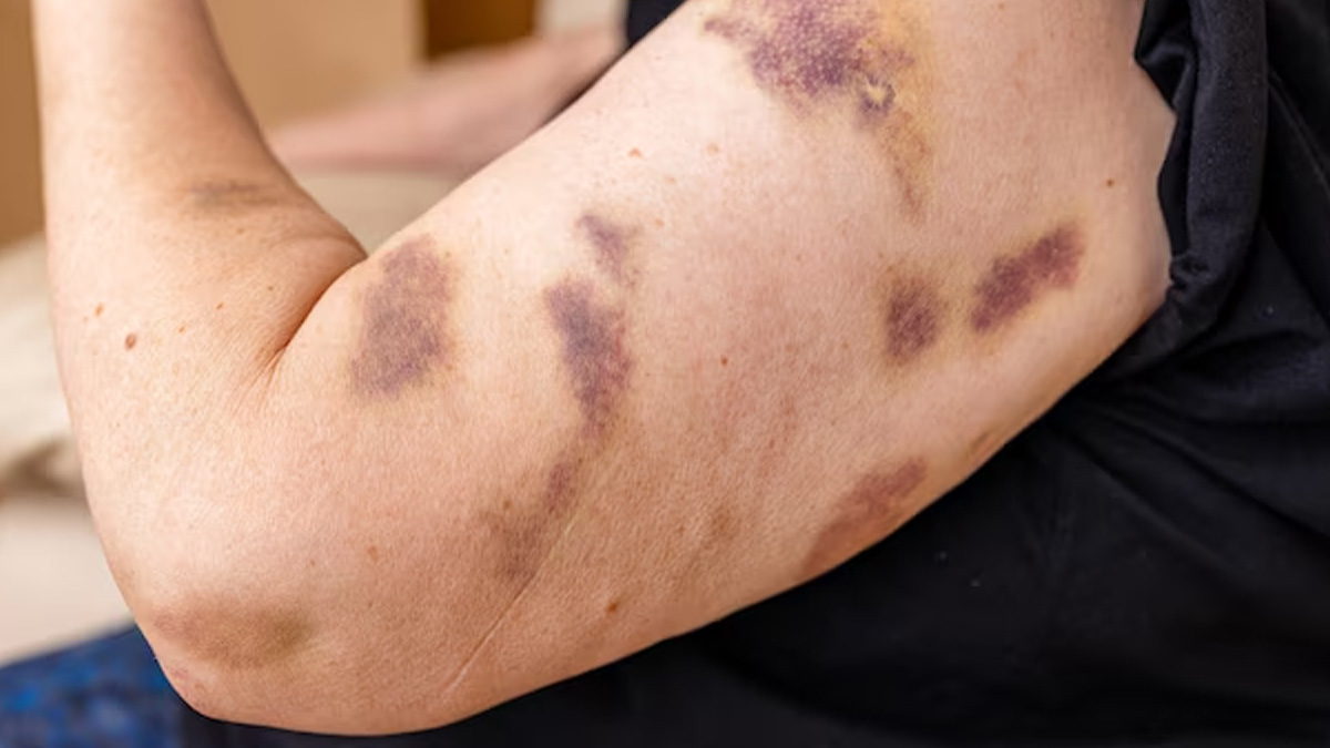 bruises-on-skin