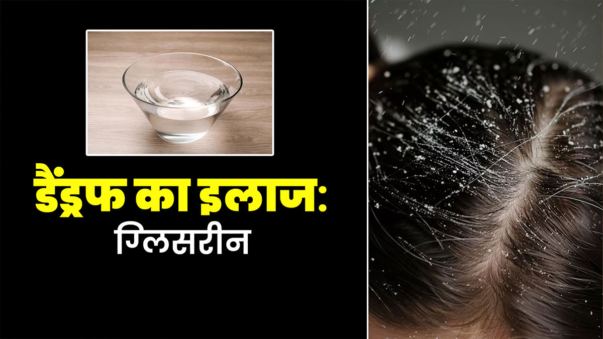 सर्दियों में डैंड्रफ दूर करने के ल‍िए ऐसे इस्‍तेमाल करें ग्लिसरीन, स्कैल्प ड्राईनेस से भी म‍िलेगा छुटकारा