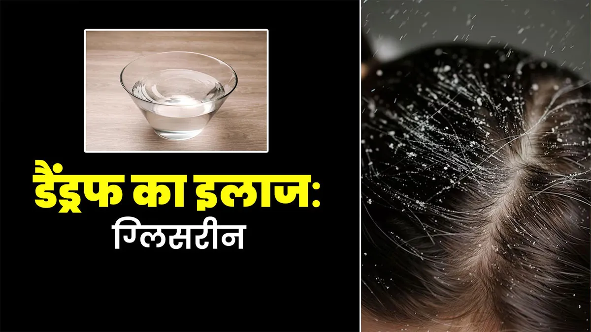 सर्दियों में डैंड्रफ दूर करने के ल‍िए ऐसे इस्‍तेमाल करें ग्लिसरीन, स्कैल्प ड्राईनेस से भी म‍िलेगा छुटकारा
