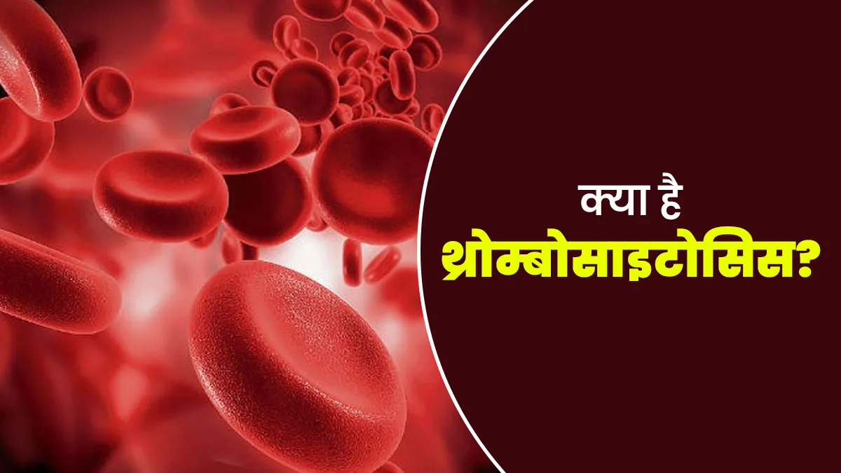 शरीर में प्लेटलेट्स बढ़ने पर होता है थ्रोम्बोसाइटोसिस? जानें इसके लक्षण और कारण