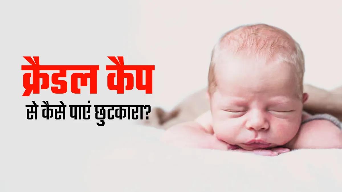 बच्चे के सिर में जमी पीली पपड़ी (क्रैडल कैप) का इलाज कैसे करें? जानें डॉक्टर से
