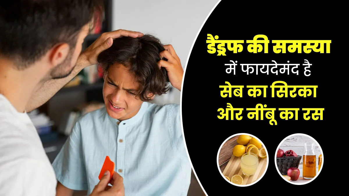 डैंड्रफ दूर करने के लिए सिर पर लगाएं एप्पल साइडर विनेगर और नींबू का रस, मिलेंगे और भी कई फायदे