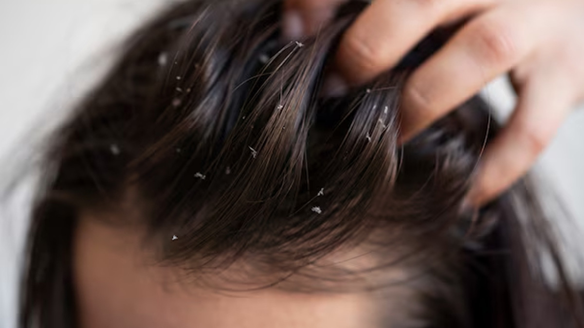 What To Avoid In Dandruff