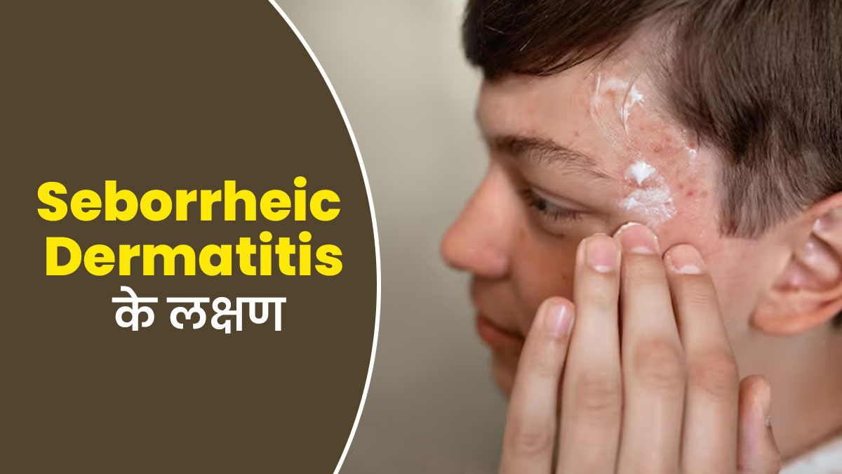 सेबोरिक डर्मेटाइटिस होने पर नजर आते हैं ये 4 लक्षण, एक्सपर्ट से जानें बचाव