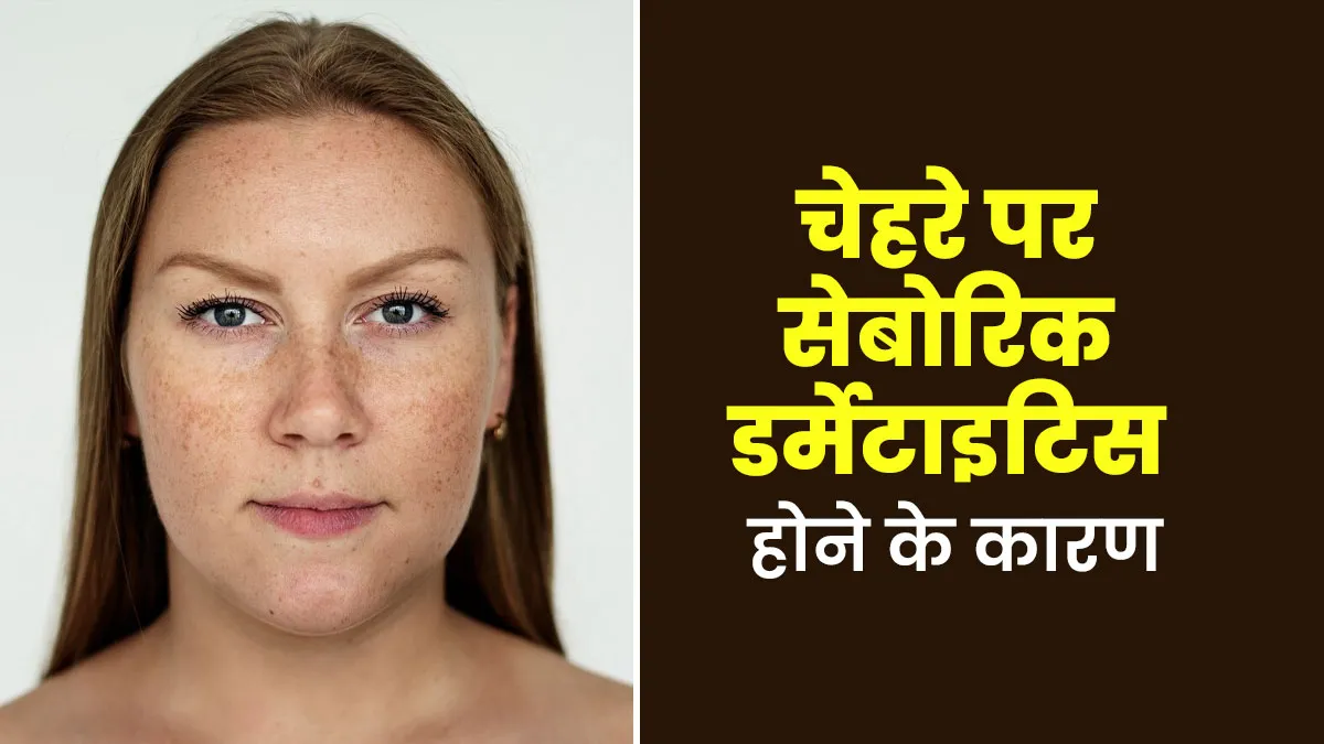 Seborrheic Dermatitis: चेहरे पर सेबोरिक डर्मेटाइटिस होने के 5 कारण, डॉक्टर से जानें इनके बारे में