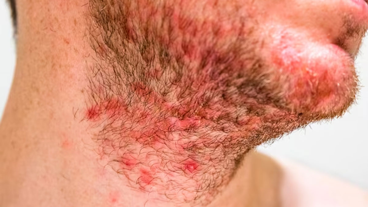 seborrheic dermatitis symptoms 01 (2)