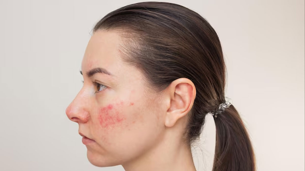 what causes seborrheic dermatitis on face01 (2)
