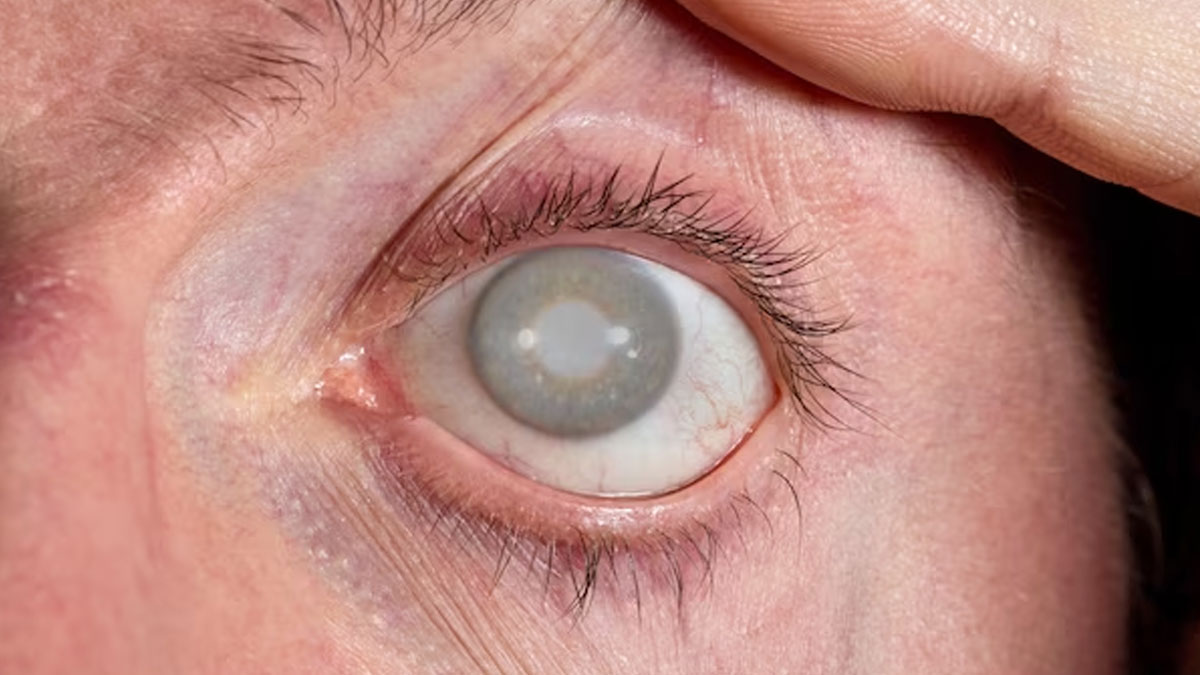 cataract regrow