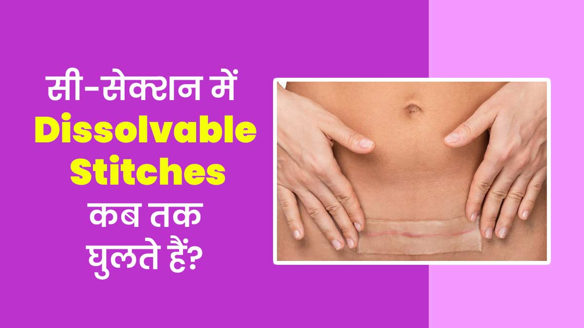 सिजेरियन डिलीवरी में लगने वाले घुलनशील टांकों को घुलने में कितना समय लगता है? डॉक्टर से जानें