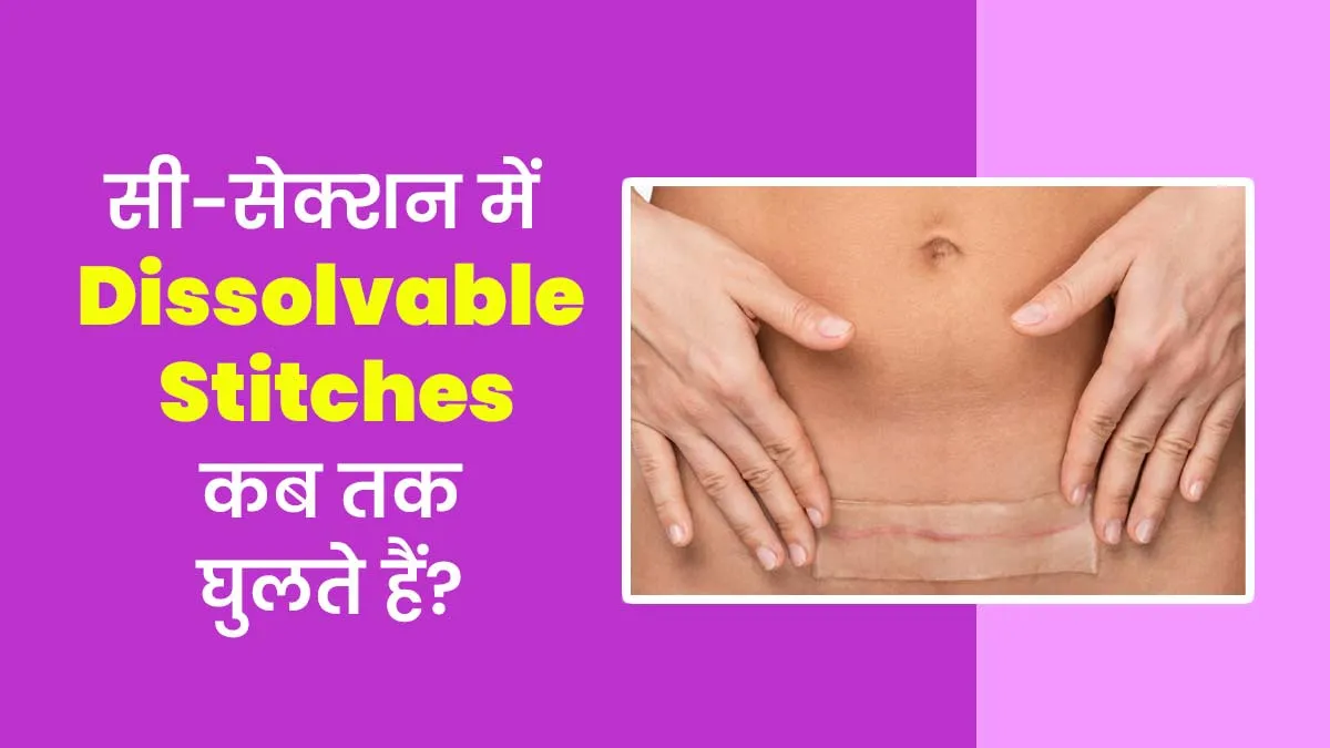 सिजेरियन डिलीवरी में लगने वाले घुलनशील टांकों को घुलने में कितना समय लगता है? डॉक्टर से जानें