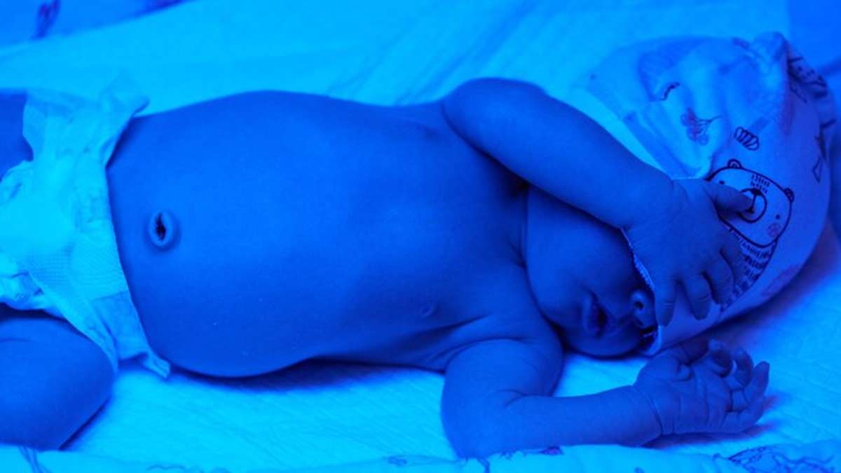 signs of recovery from jaundice in newborns 01 (2)