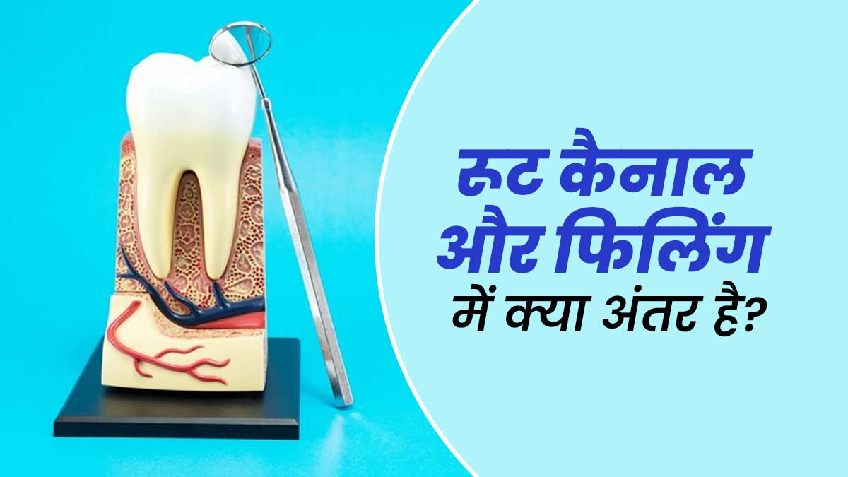रूट कैनाल vs फिलिंग: डैमेज दांतों के इलाज के ल‍िए कौन सा ट्रीटमेंट कब क‍िया जाता है? एक्‍सपर्ट से जानें 
