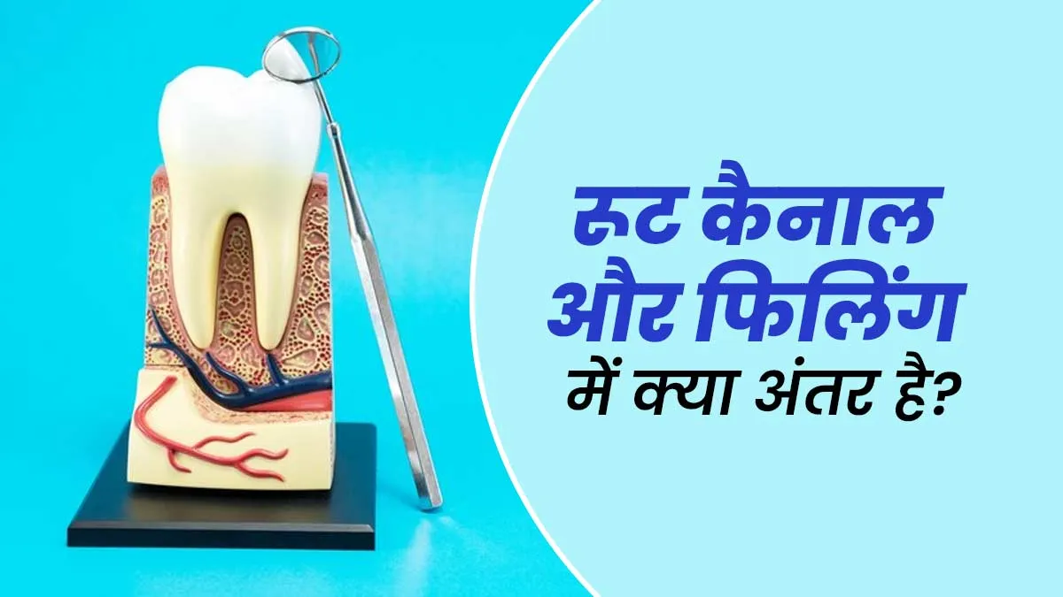 रूट कैनाल vs फिलिंग: डैमेज दांतों के इलाज के ल‍िए कौन सा ट्रीटमेंट कब क‍िया जाता है? एक्‍सपर्ट से जानें 
