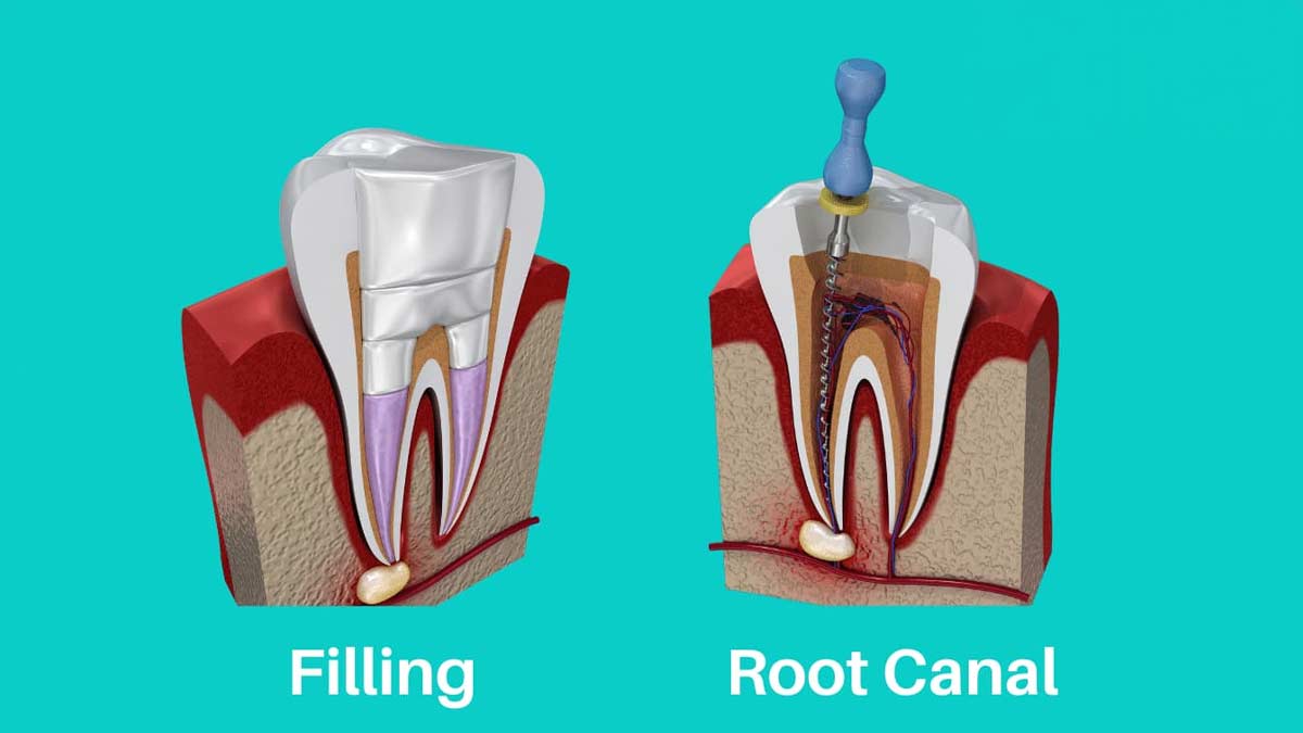 root-canal-and-filling