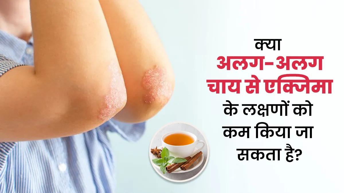 एक्जिमा के लक्षणों को कम करने में फायदेमंद हो सकती हैं कुछ चाय? एक्सपर्ट से जानें इनके बारे में