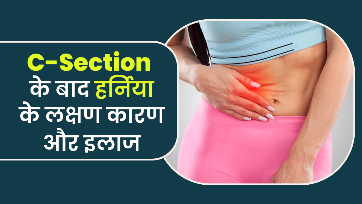 सिजेरियन डिलीवरी के बाद ये 5 लक्षण हो सकते हैं हर्निया (Hernia) का संकेत, डॉक्टर से जानें इसके कारण और इलाज