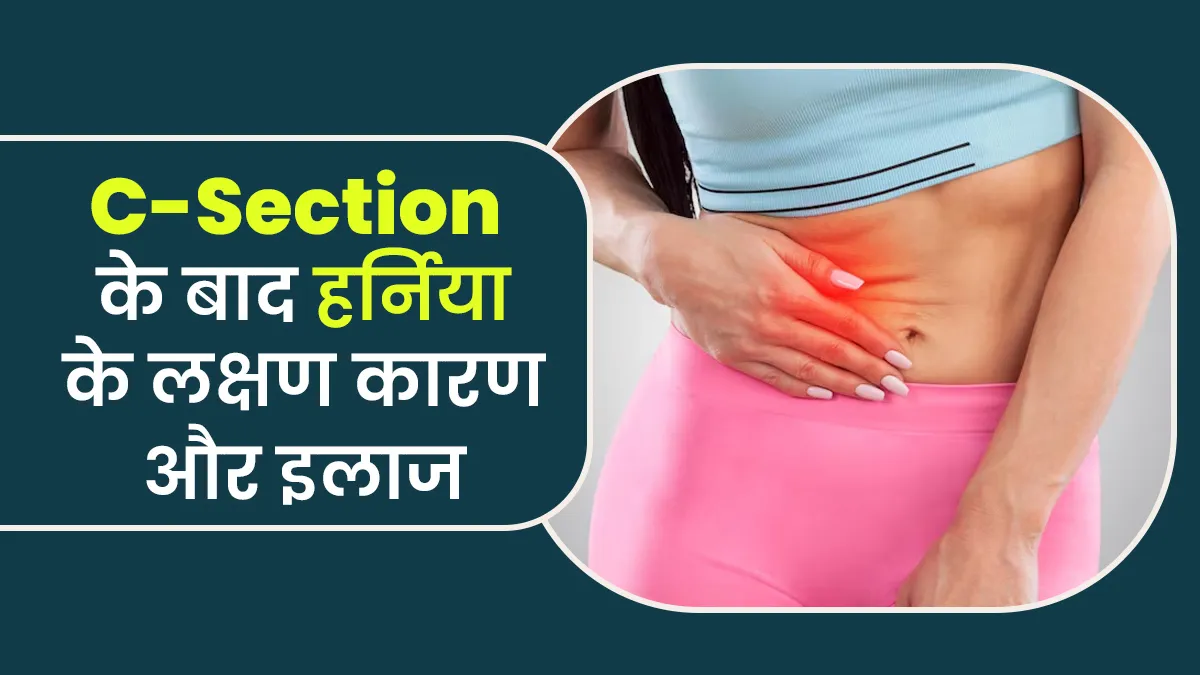 सिजेरियन डिलीवरी के बाद ये 5 लक्षण हो सकते हैं हर्निया (Hernia) का संकेत, डॉक्टर से जानें इसके कारण और इलाज