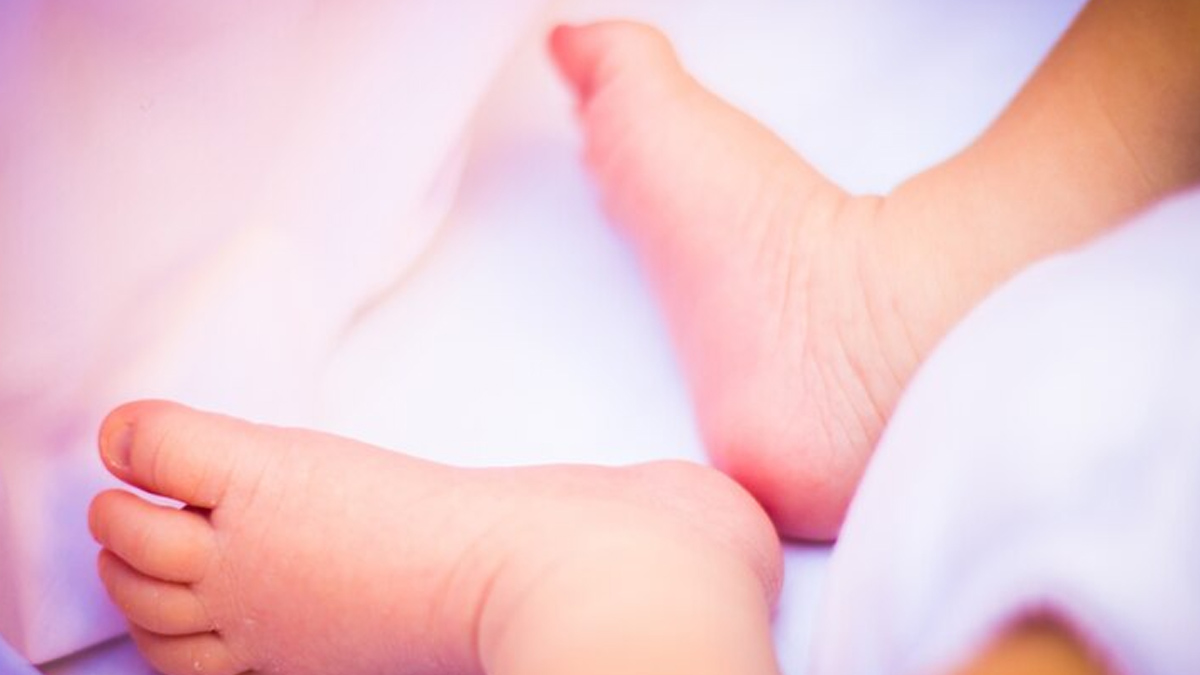 When is club foot best treated