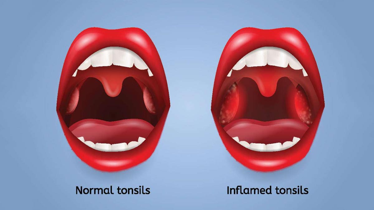 tonsil-in-kids