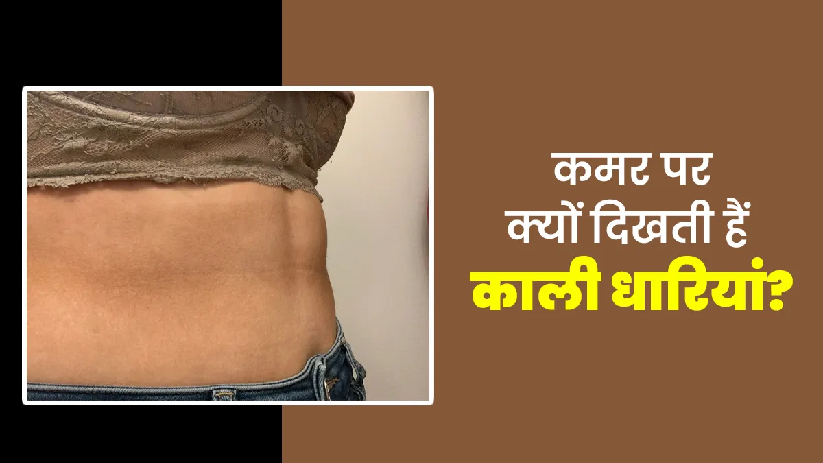 कमर पर क्‍यों द‍िखती हैं काली धार‍ियां? एक्‍सपर्ट से जानें कारण और इसे दूर करने के उपाय