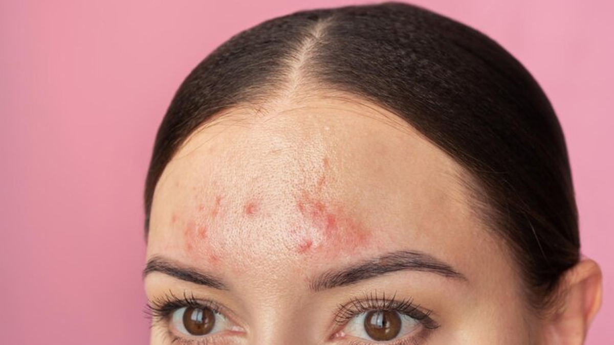 forehead-pimples