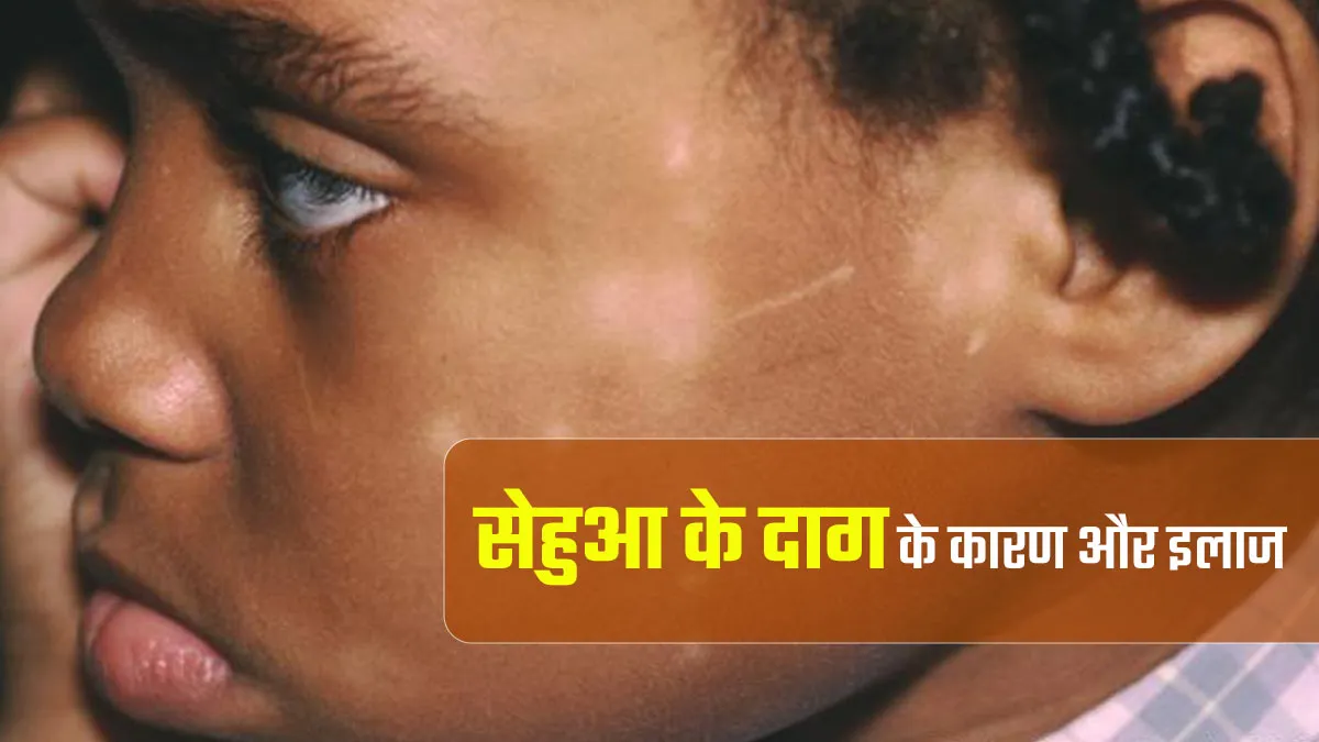 बच्चे की त्वचा पर नजर आने वाले धब्बे हो सकते हैं सेहुआ के दाग, जानें इसका कारण और बचाव के उपाय