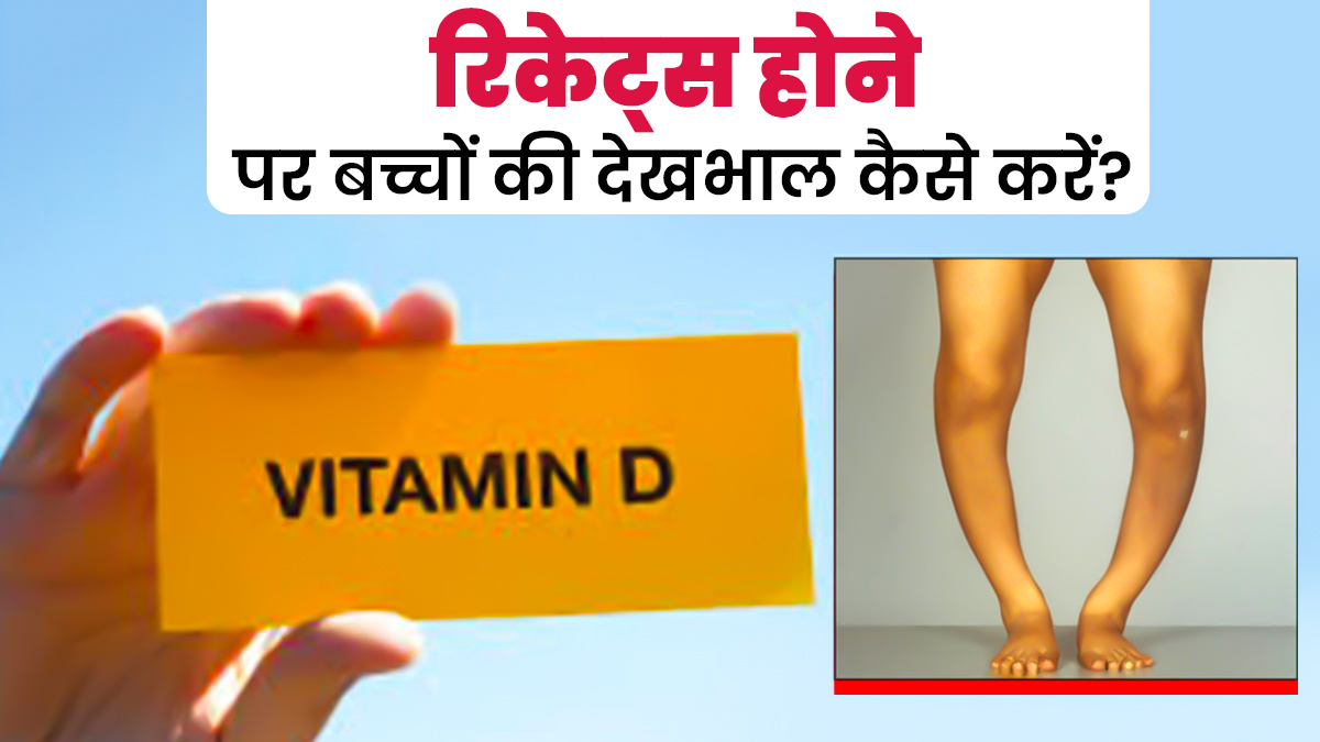 रिकेट्स (सूखा रोग) होने पर बच्चों की देखभाल कैसे करनी चाहिए? जानें डॉक्टर से