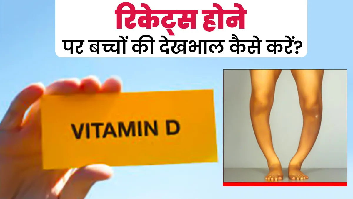 रिकेट्स (सूखा रोग) होने पर बच्चों की देखभाल कैसे करनी चाहिए? जानें डॉक्टर से