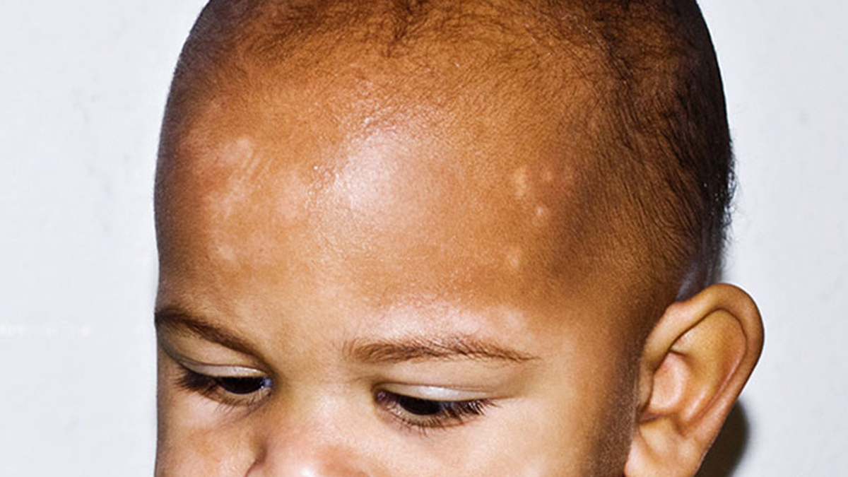 Child-Pityriasis-Alba-causes-prevention-Tips-inside