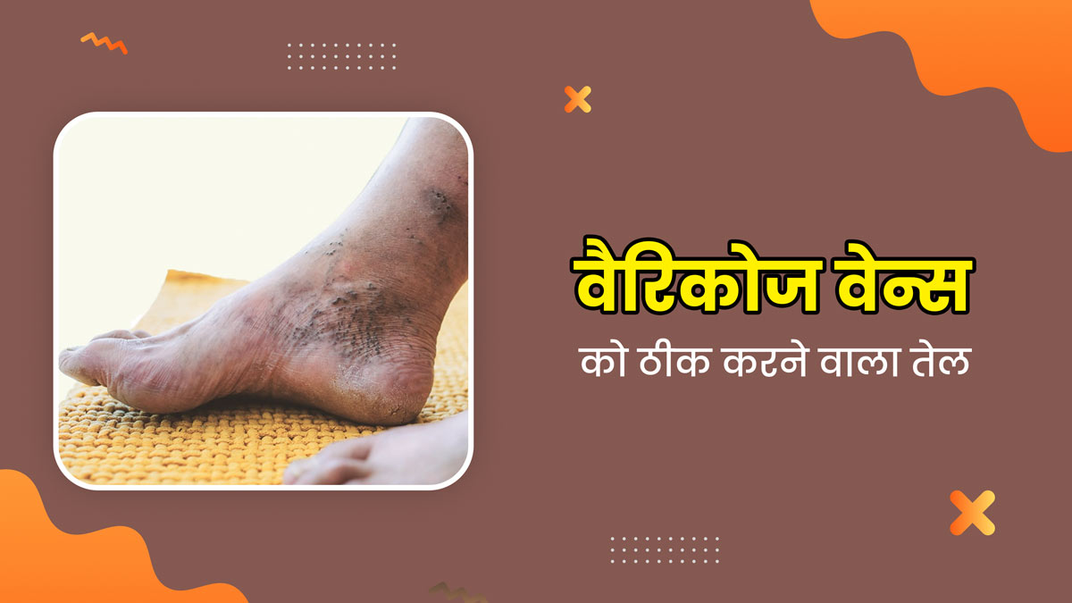 Varicose Veins: वेरिकोज वेन्स (उभरी नीली नसों) को ठीक कर सकता है ये आयुर्वेदिक तेल, जानें बनाने का तरीका