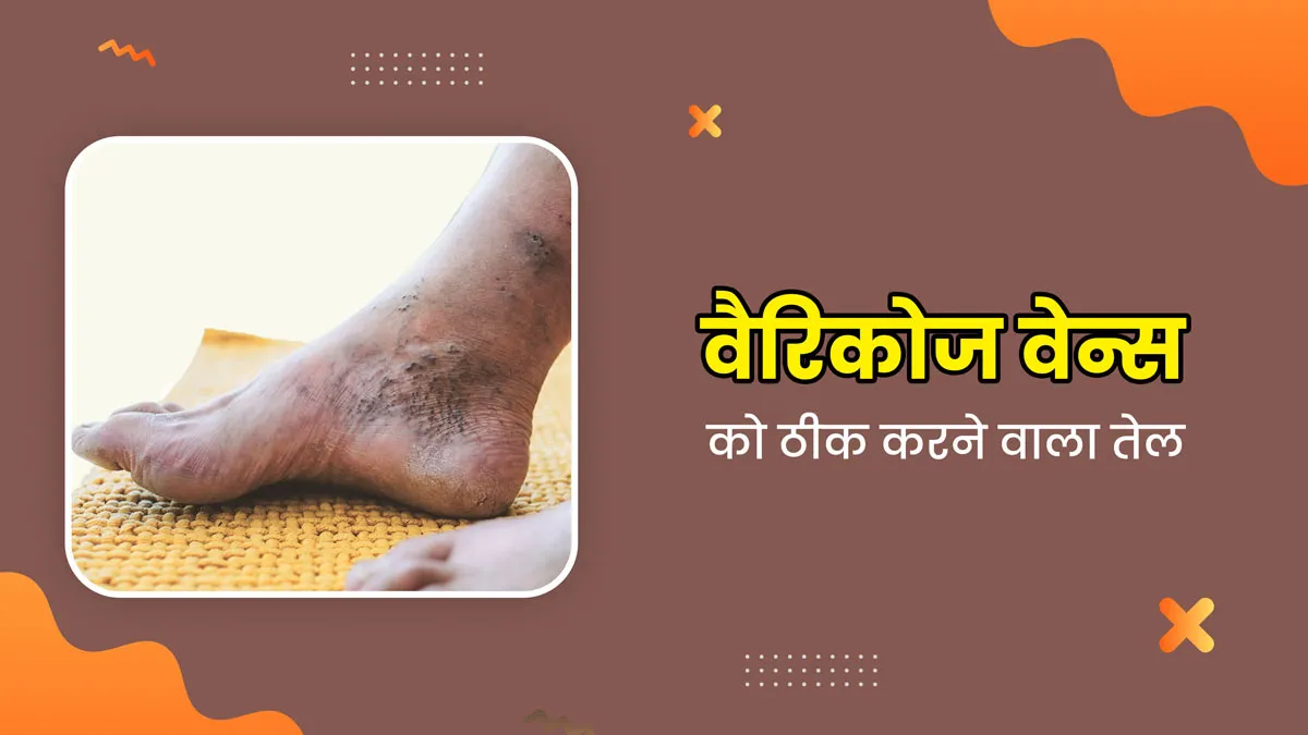Varicose Veins: वेरिकोज वेन्स (उभरी नीली नसों) को ठीक कर सकता है ये आयुर्वेदिक तेल, जानें बनाने का तरीका
