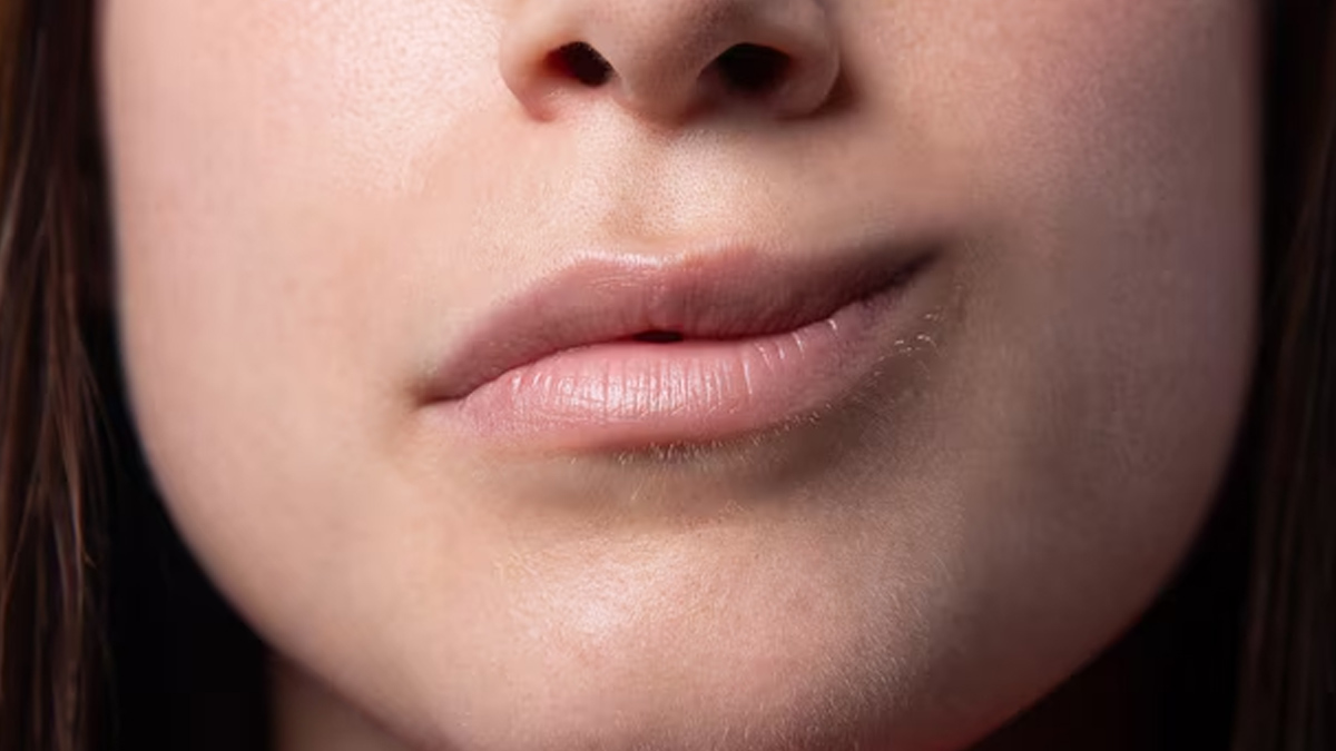 complications-of-bells-palsy-in