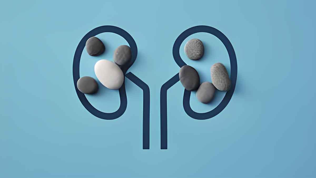 food-to-Avoid-in-Kidney-stone-insid2