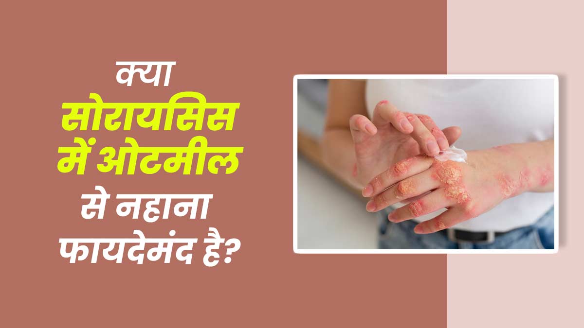 सोरायसिस की खुजली से राहत के लिए पानी में ओट्स डालकर नहाना है फायदेमंद, डॉक्टर से जानें सही तरीका