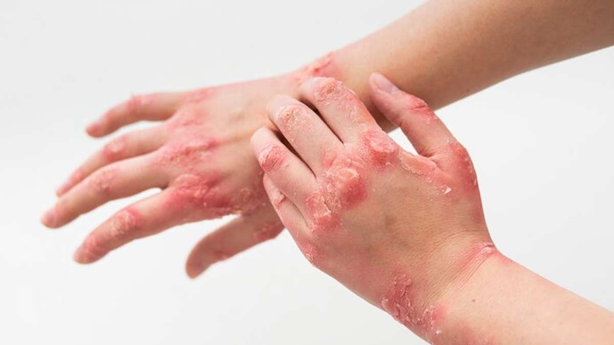 oatmeal bath for psoriasis