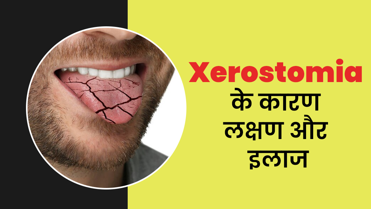मुंह सूखने की बीमारी को कहते हैं जेरोस्टोमिया, जानें इसके कारण लक्षण और इलाज