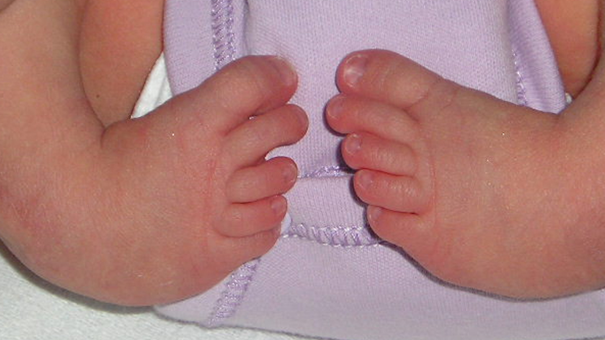 Is clubfoot curable doctor