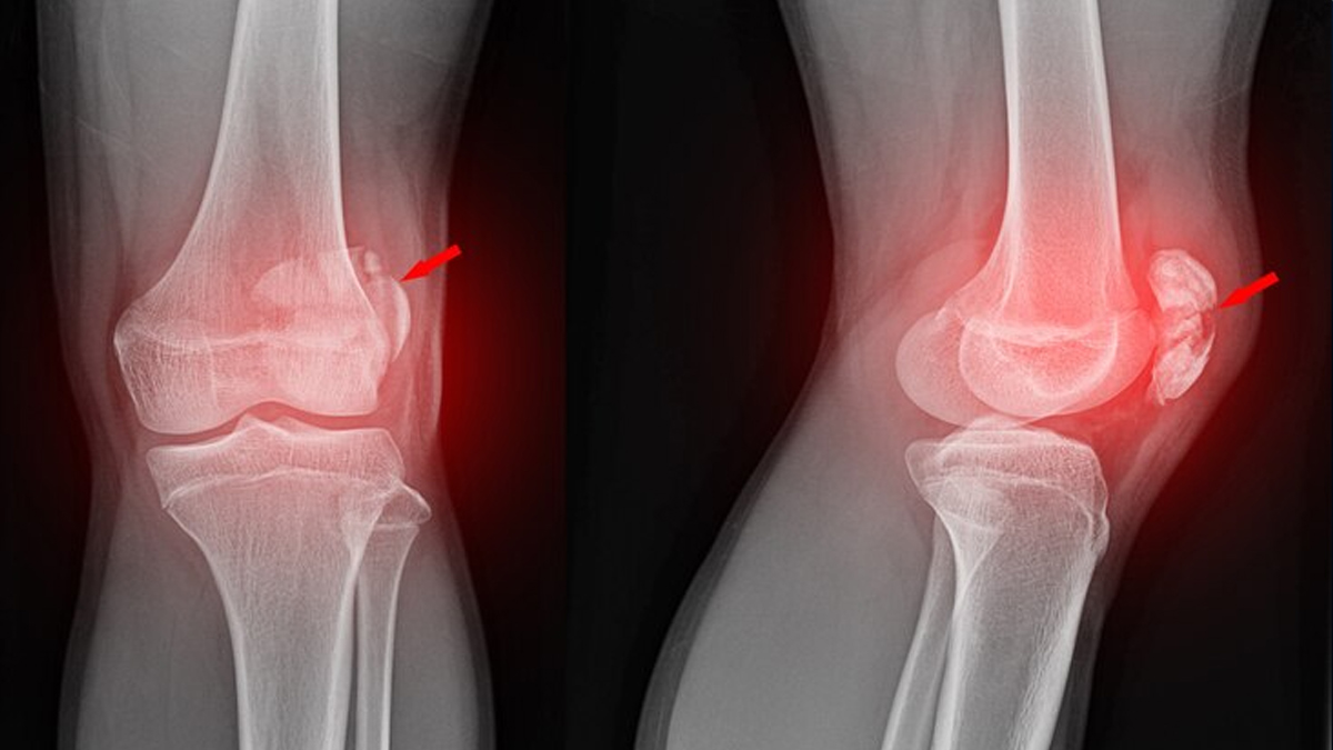 pseudoarthrosis tibia causes symptoms