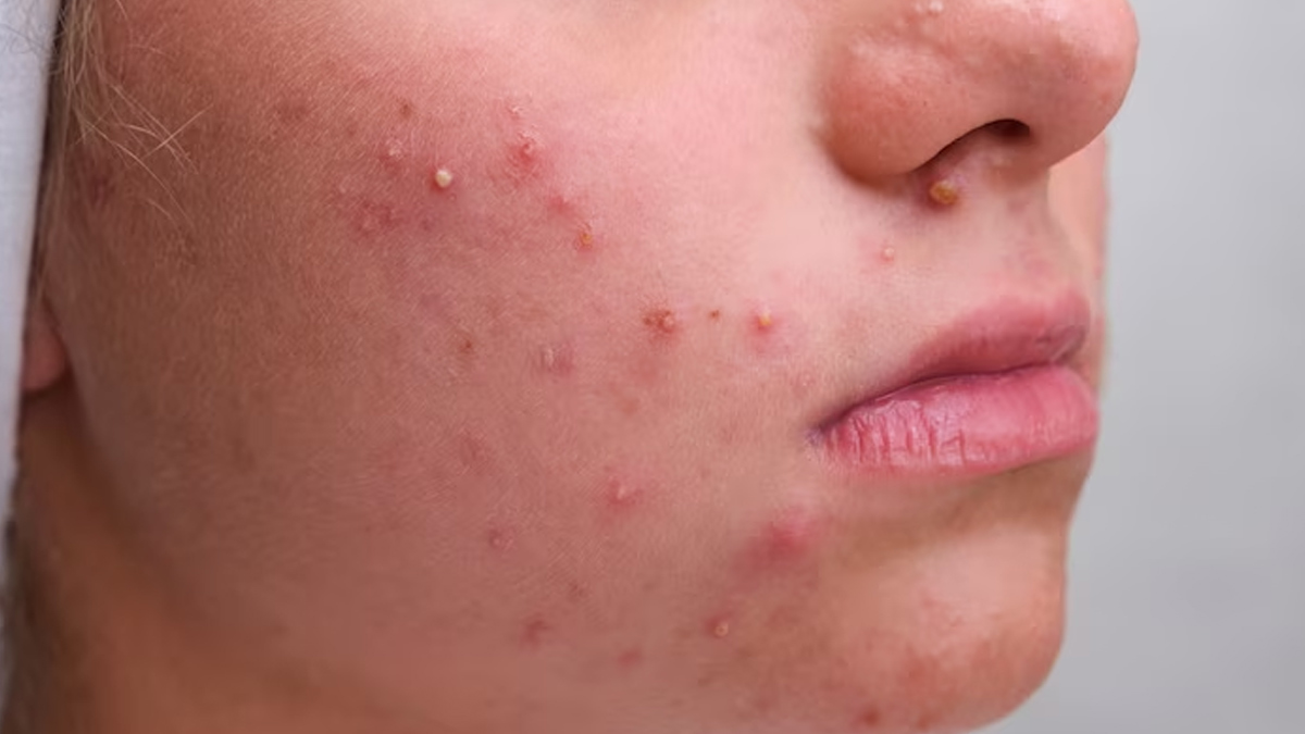 Skin-Problem-Due-to-Calcium-Deficiency-inside