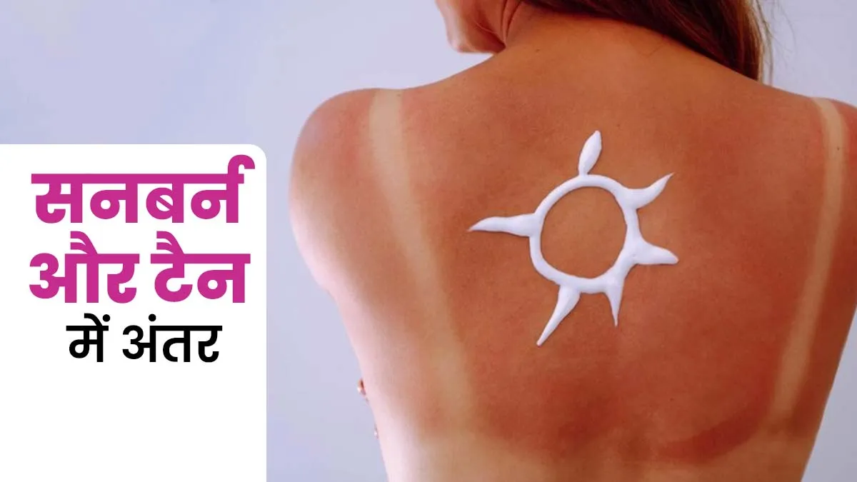 सनबर्न और टैनिंग में क्या अंतर है? डॉक्टर से जानें