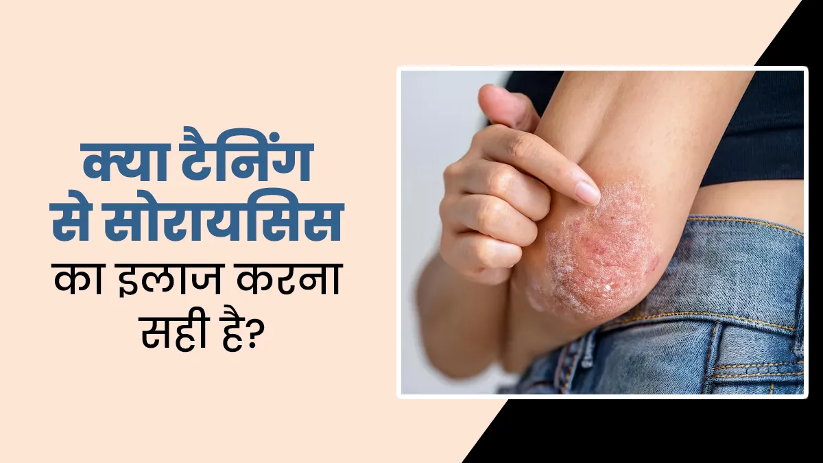 क्या टैनिंग से सोरायसिस का इलाज करना सुरक्षित है? जानें डॉक्टर की राय