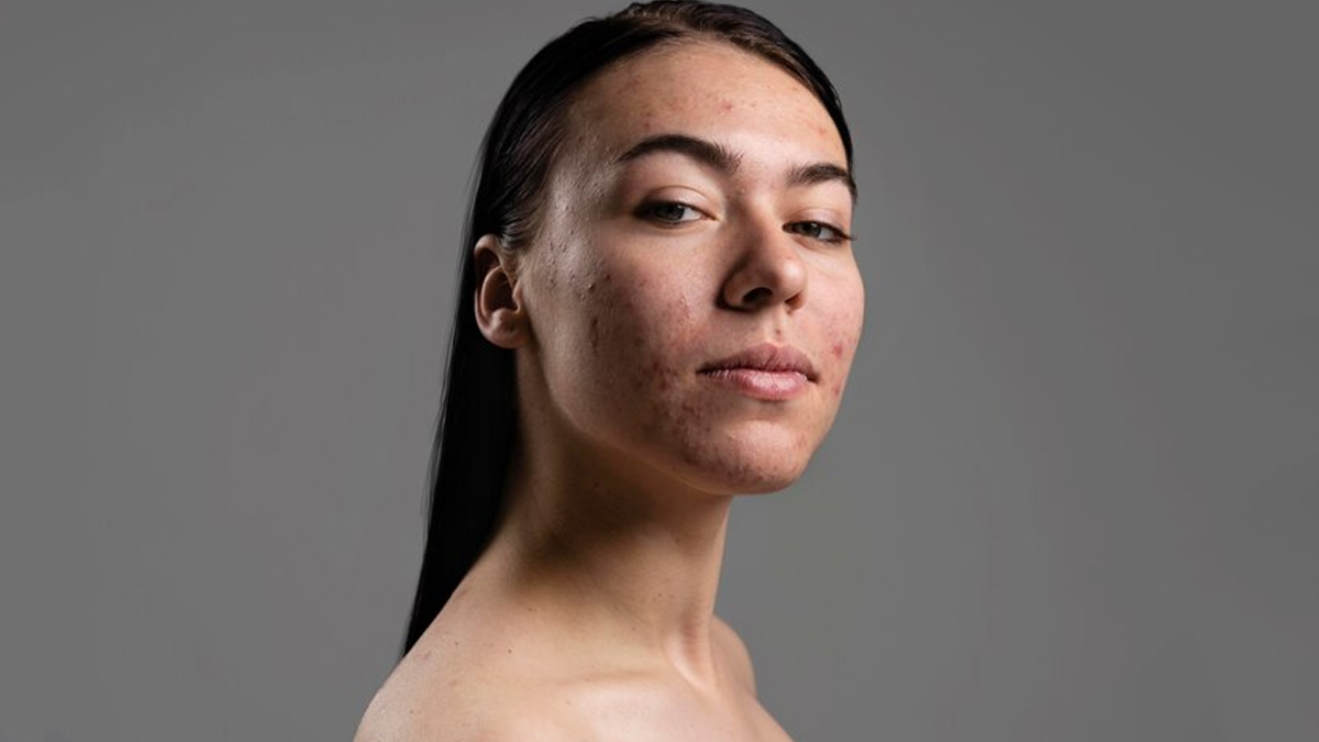 How to Identify Hyperpigmentation