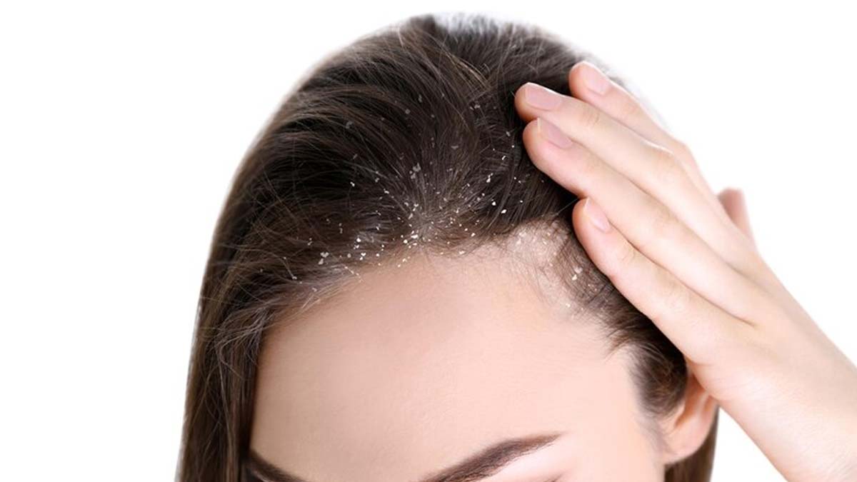 why does dandruff problem occur after delivery 01