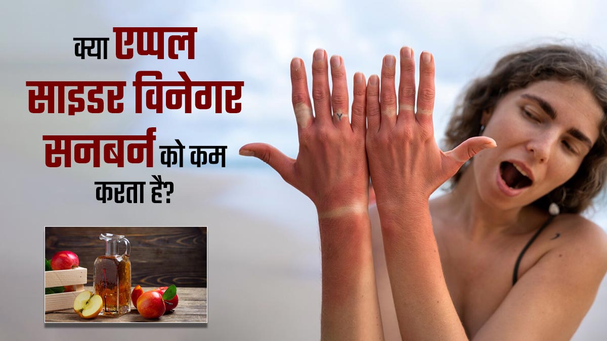 क्या एप्पल साइडर विनेगर सनबर्न को दूर करता है? डॉक्टर से जानें