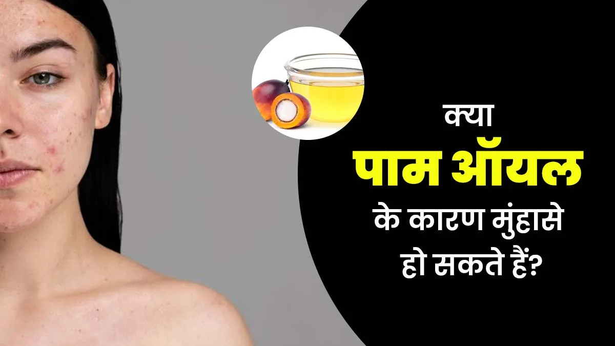 मुंहासों का कारण कहीं पाम ऑयल वाले फूड्स तो नहीं? एक्सपर्ट से जानें