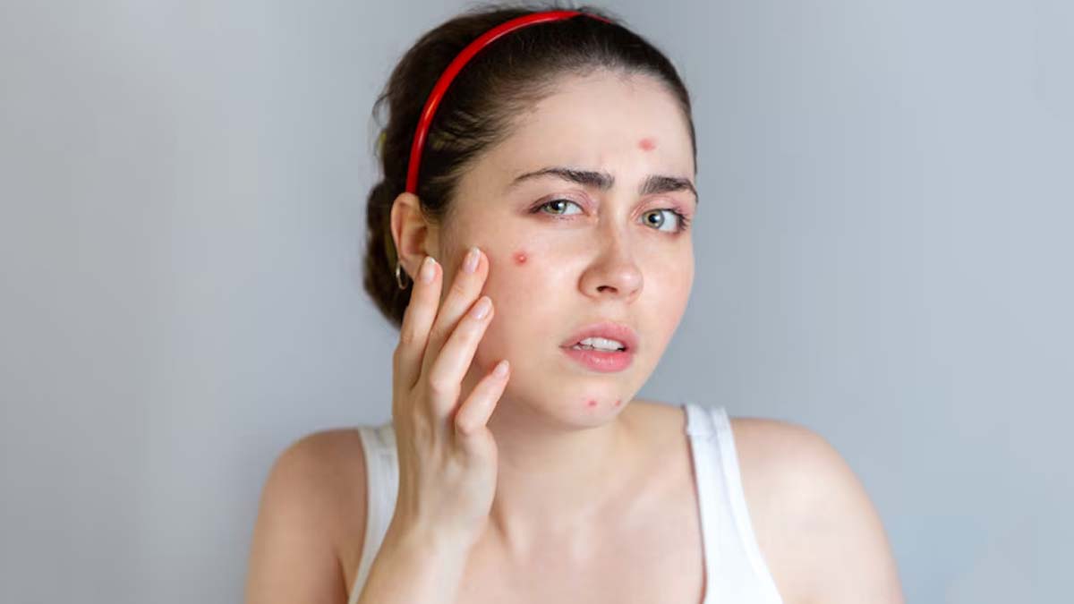 does-palm-oil-cause-acne-in